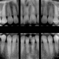 More research finds little evidence of dental x-ray/cancer link