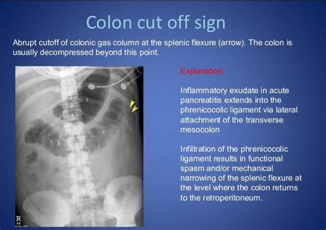 Sentinel Loop Pancreatitis Colon Cut Off Sign