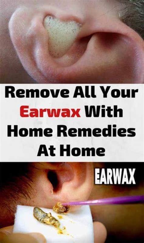 HOW TO USE HYDROGEN PEROXIDE TO REMOVE EAR WAX? in 2020 | Ear wax, Ear ...