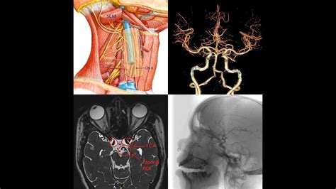 Part 1-INTERNAL CAROTID ARTERY.Clinical & Surgical anatomy,Real time Arteriography,MRI & CT ...