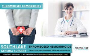 Thrombosed Hemorrhoids – Southlake General Surgery