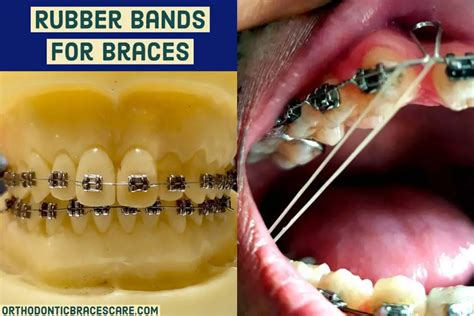 Braces Rubber Bands: Purpose, Types, Colors, How To Put - Orthodontic Braces Care