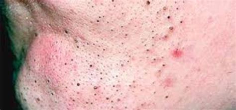 4 Common Skin Conditions (Blackheads, Whiteheads, Congestion & Cystic Acne) - Studio You