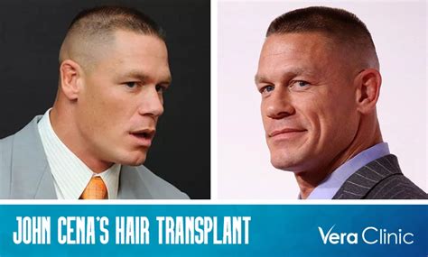 John Cena Bald Spot: His Hair Transplant Journey