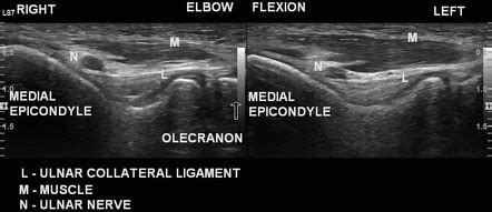 Anconeus epitrochlearis | Radiology Case | Radiopaedia.org