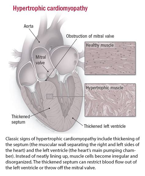 Cardiomyopathy: Symptoms, diagnosis and treatment - Harvard Health