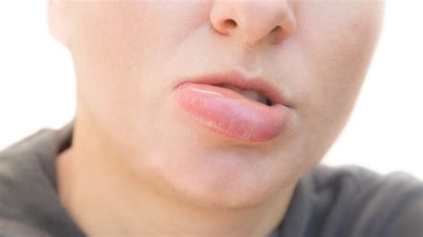 Swollen Bottom Lip, Causes, For No Reason, Treatment of Lower Lips ...