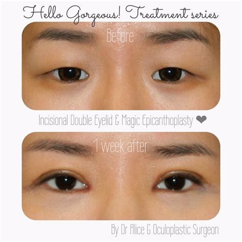 Dr. Alice Goh: Doctor, I want a double eyelid but do I need an epicanthoplasty? 医生，我想有双眼皮，但我需要开眼头吗？