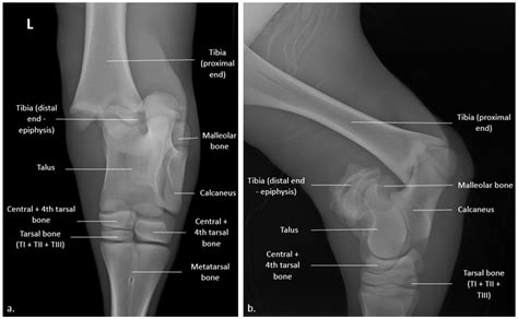 Epiphyseal Fracture X Ray