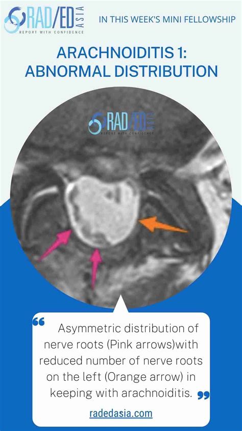 ARACHNOIDITIS MRI SPINE ONLINE RADIOLOGY COURSE - Radedasia