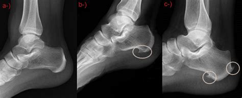 Plantar Calcaneal Enthesophyte Symptoms Sale Online | bellvalefarms.com