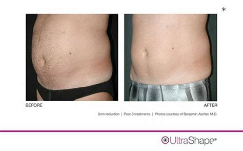 UltraShape Non Surgical Fat Reduction for Men