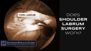 Shoulder Labrum Surgery: Does It Work? | Centeno-Schultz