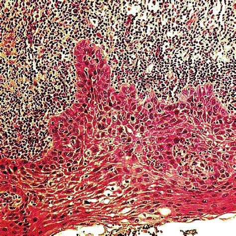 This histological image illustrates severe dysplasia with a chronic... | Download Scientific Diagram