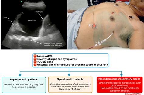 Pleural Effusion Treatment