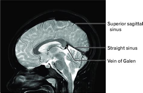 Inferior Sagittal Sinus Mri | Porn Sex Picture