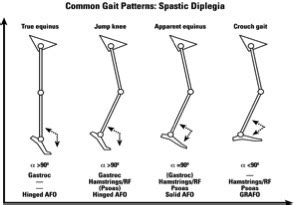 Classification of Gait Patterns in Cerebral Palsy - Physiopedia