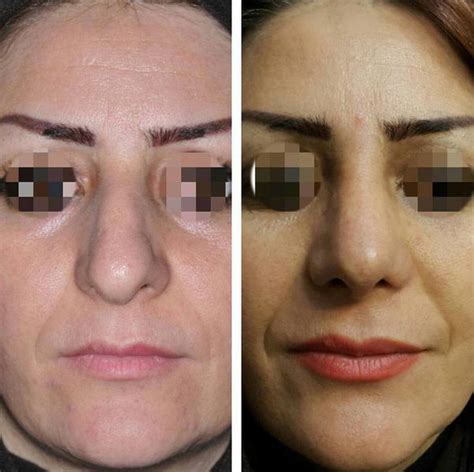 Bulbous Nose Surgery Before And After Photos » Rhinoplasty: Cost, Pics ...