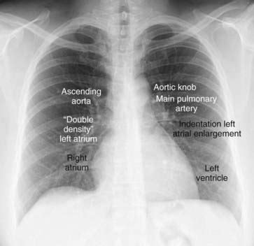 Normal Heart X Ray Images - Well, here are a few videos, images, books, mnemonics, apps and ...