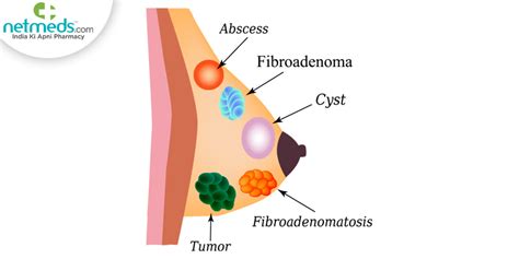 Fibroadenoma: Causes, Symptoms and Treatment