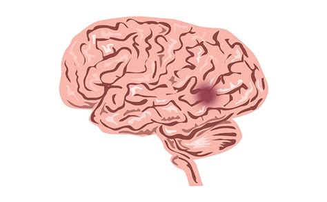 Brain Hemorrhage Recovery Time, Causes, and Symptoms