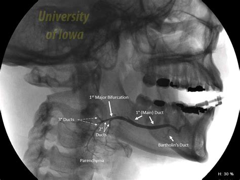 Submandibular Duct