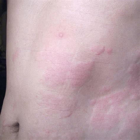 What causes a rash that moves to different parts of the body?