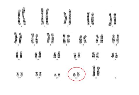 Síndrome de Lenz : Un poco del cromosoma 22