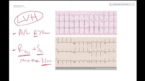 LVH on ECG (Left ventricular hypertrophy) - Learn ECG! - Dr Jamal USMLE ...