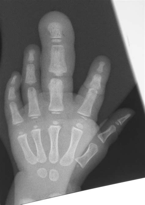 Congenital Hand and Arm Differences: Macrodactyly- Big fingers