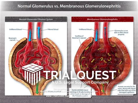 Normal Glomerulus vs. Membranous Glomerulonephritis - TrialExhibits Inc.