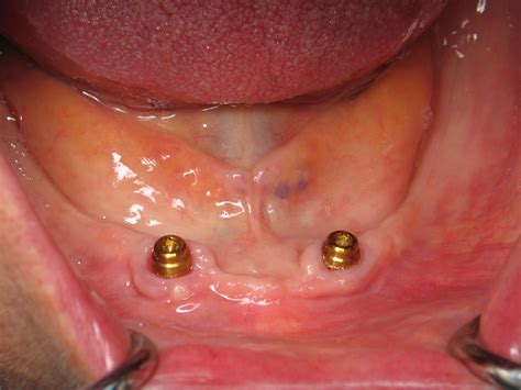 Snap In Dentures on Dental Implants – Burbank Dental Implant Specialist | Ramsey Amin, DDS