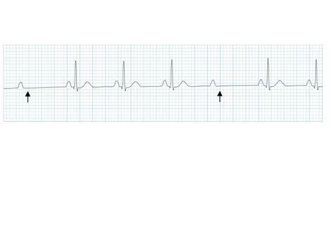 ECG Lecture: Sinus arrest, sinoatrial exit block, AV block and escape…