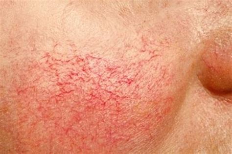 Telangiectasia | Broken capillaries, Rosacea, How to treat rosacea