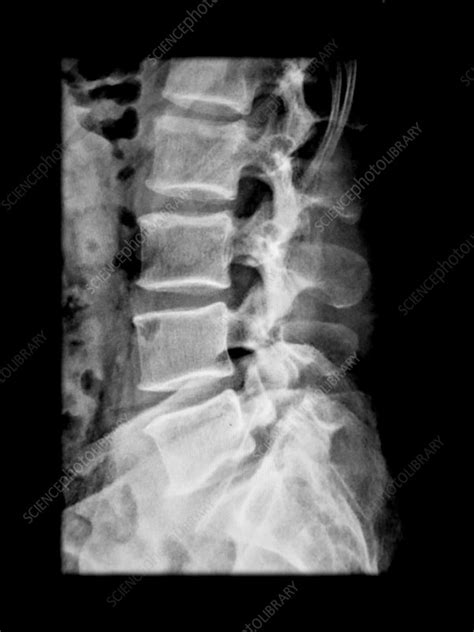 X-ray of Lumbar Spondylolysis L5 - Stock Image - C043/0222 - Science Photo Library