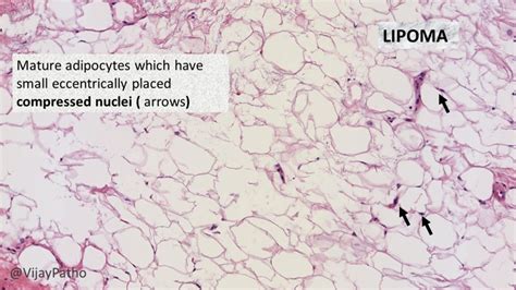 Pathology of Lipoma - Pathology Made Simple