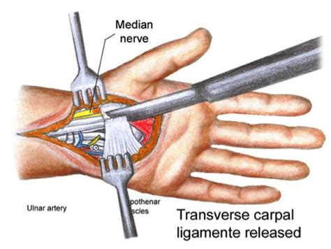 Have You Got Carpal Tunnel? My Journey to Recovery, and Creation of the RBT