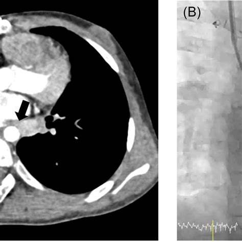 Posterior aortopexy technique. (A) Descending aorta (DA) was fixed to... | Download Scientific ...