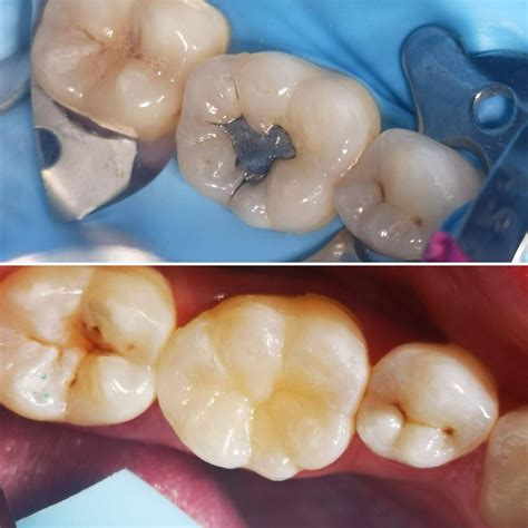 Amalgam filling replacement with composite - Private Dentistry