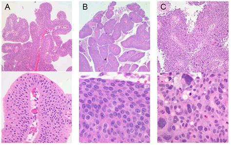 Contemporary Management and Trends in the Treatment of Upper Tract Urothelial Carcinoma | Abbott ...