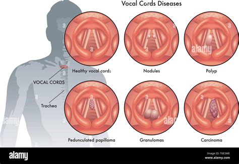 Anatomy Of Vocal Cords