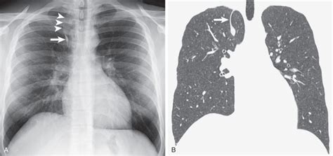 Normal Chest Radiography and Computed Tomography | Radiology Key