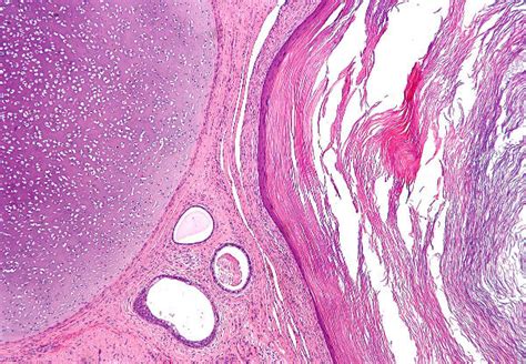 Most common type of teratoma of the testis is? - Surgery MCQ « PG Blazer