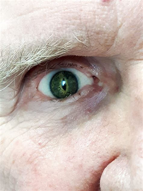 Ocular Prosthesis | Blog | Westcoast Brace and Limb