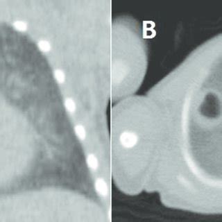 Low dose chest CT with pneumatocele (1.3×1.0 cm) in right upper lobe.... | Download Scientific ...