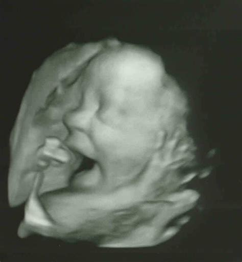 Secular Pro-Life Perspectives: Baby Chris is 28 Weeks Old