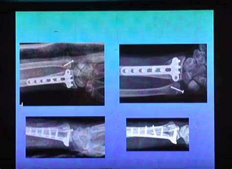 Current Trends in Ulnar styloid fractures — OrthopaedicPrinciples.com