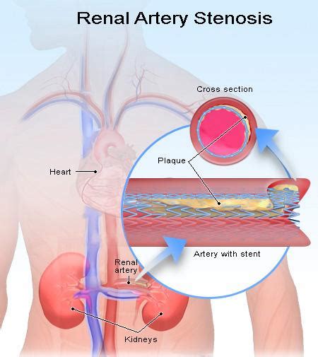 Renal artery stenosis how is the diagnosis? | Medical Help, Health Tips