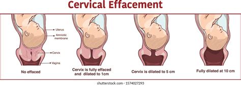 157 imagens de Cervix dilation Imagens, fotos stock e vetores ...