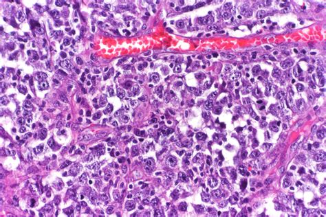 Current Frontline Treatment of Diffuse Large B-Cell Lymphoma